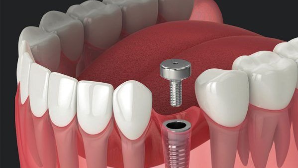 Best Implant Dentist in Punawale,  Implant Dentist in Punawale,  Dental Implants Punawale,  Dental Implant Clinic Punawale,  Tooth Implant Specialist Pune,  Dental Implant Treatment Pune,  Missing Teeth Replacement Pune,  Full Mouth Dental Implants Pune,  Single Tooth Implant Pune,  Dr. Hileri Mori Pune