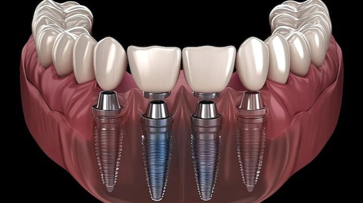 Implants for Missing Teeth,  Dental Implants in Pune,  Missing Teeth Treatment Pune,  Dental Implants for Missing Teeth,  Tooth Replacement Pune,  Dental Implant Treatment Pune,  Single Tooth Implant Pune,  Multiple Tooth Implants Pune,  Best Dental Implants Pune,  Trusted Dental Implants Pune