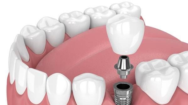 Front teeth correction,  Front teeth correction Pune,  Front teeth correction treatment Pune,  Front teeth correction dentist Pune,  Front teeth alignment Pune,  Front teeth correction specialist Pune,  Front teeth aesthetic treatment Pune,  smile correction Pune,  dental aesthetics Pune,  Dr. Hileri Mori Pune
