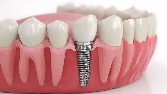 full mouth rehabilitation doctor Pune,  full mouth rehabilitation expert Pune,  full mouth rehabilitation services Pune,  full mouth dental restoration specialist Pune,  complete mouth rehabilitation Pune,  restorative dental treatment Pune,  advanced full mouth restoration Pune,  comprehensive smile rehabilitation Pune,  dental reconstruction Pune,  oral restoration specialist Pune