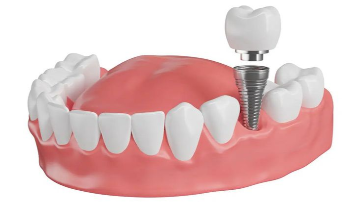 dental implants pune,  dr hileri mori,  implantologist in pune,  tooth replacement pune,  painless dental implants,  full mouth implants pune,  best dentist in pune,  fixed teeth cost pune,  prosthodontist pune,  harmony dental clinic