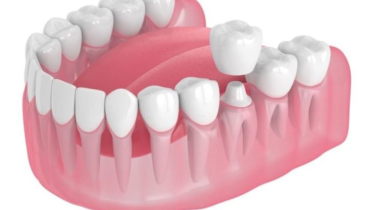 implant specialist in Pune,  dental implant expert Pune,  implant treatment specialist Pune,  tooth implant clinic Pune,  dental implant care Pune,  advanced implant dentistry Pune,  missing tooth implant Pune,  permanent teeth replacement Pune,  implant consultation Pune,  Dr Hileri Mori dental implants