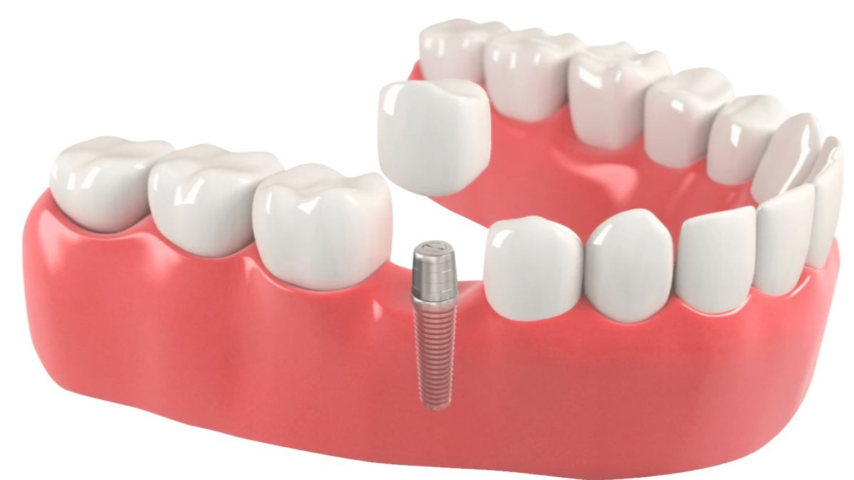 tooth implant,  tooth implant in Pune,  tooth implant cost Pune,  tooth implant treatment Pune,  dental implant Pune,  tooth replacement Pune,  tooth implant dentist Pune,  tooth implant specialist Pune,  missing tooth replacement Pune,  Dr. Hileri Mori